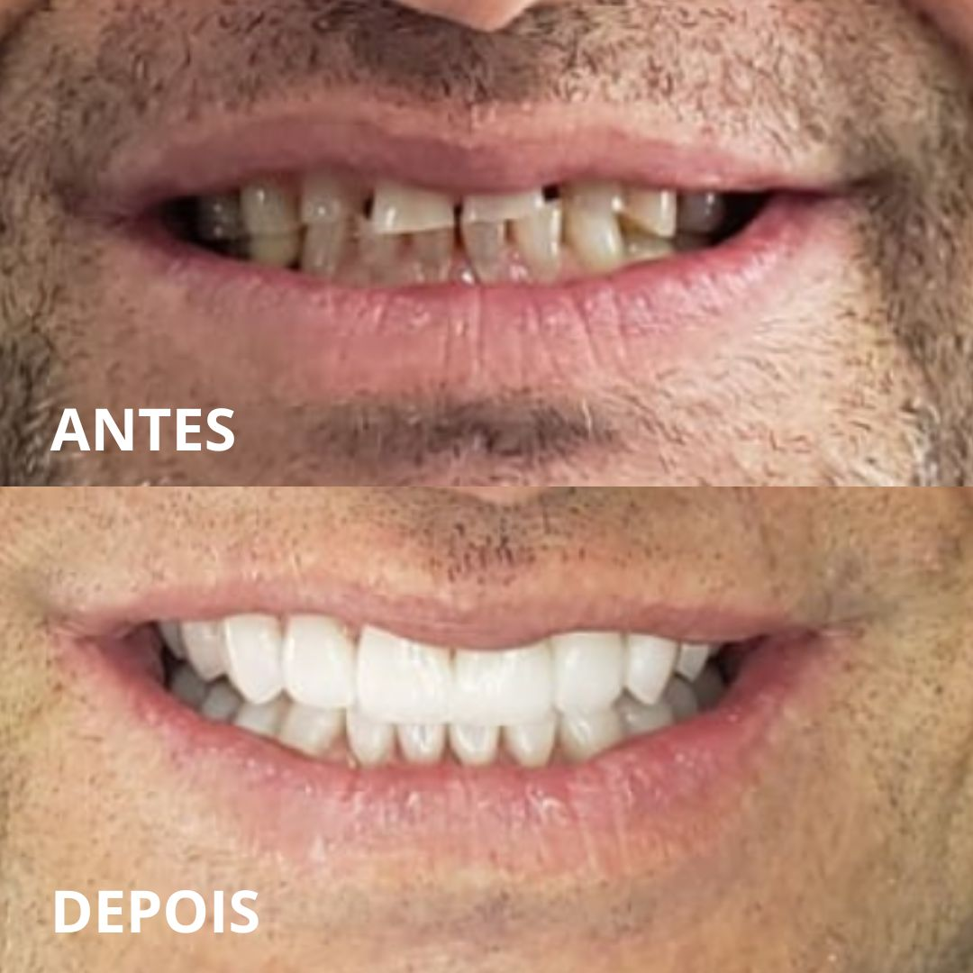 Caso de Sucesso - Antes e Depois de Implante